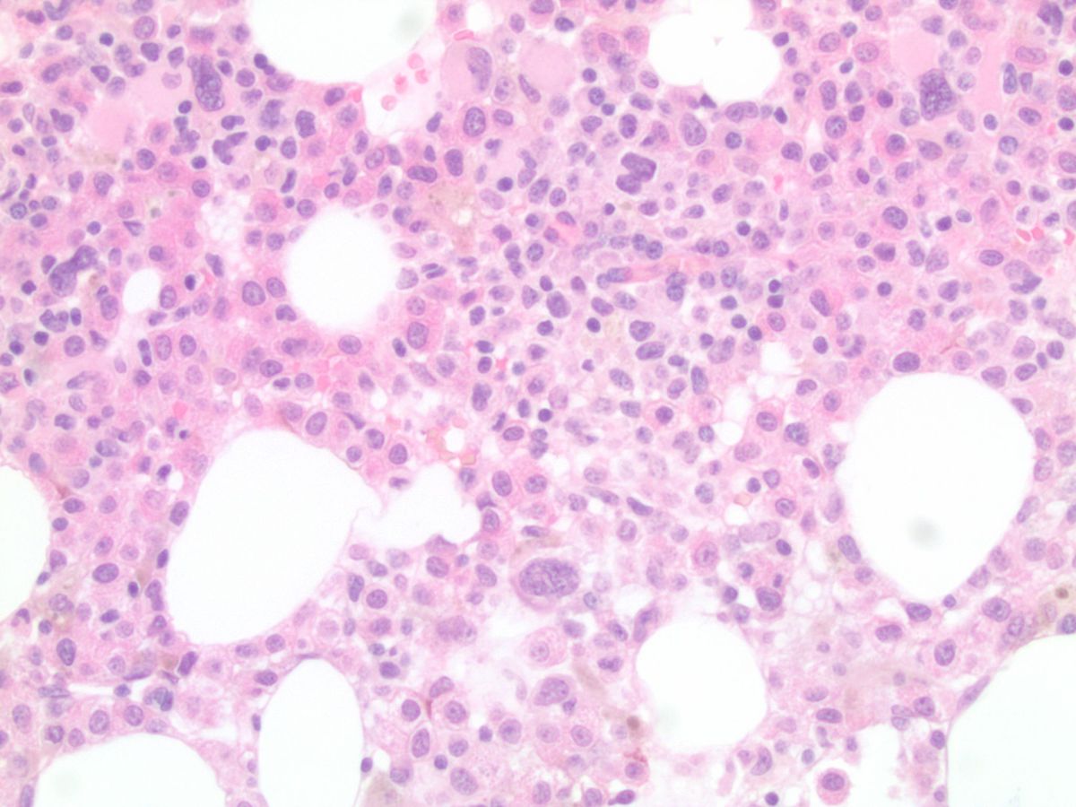 Day 22 bone marrow biopsy high power
